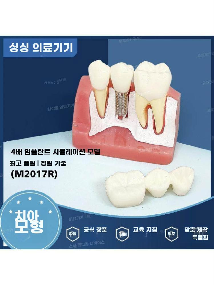 임플란트 모형 치아 모델 치과 구강 이빨 교구 시연 임플란트 운동 모델 (상악) - 상세 이미지 2