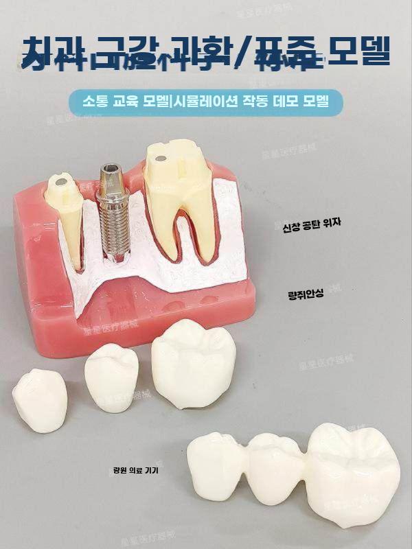 임플란트 모형 치아 모델 치과 구강 이빨 교구 시연 임플란트 운동 모델 (상악) - 상세 이미지 4
