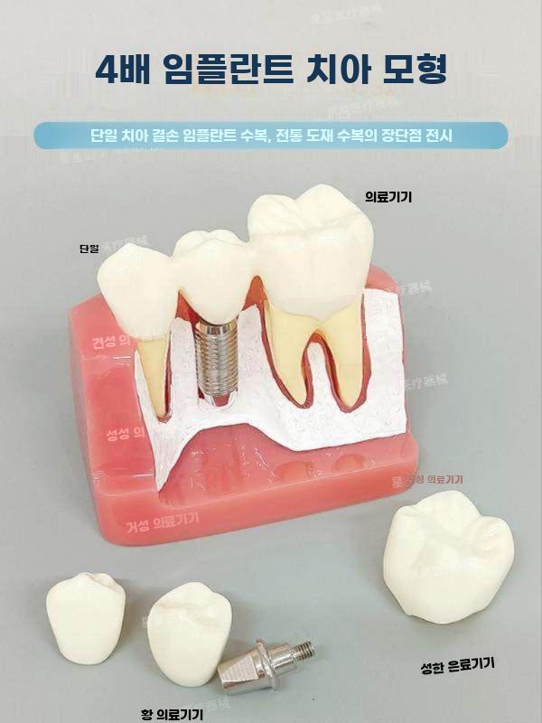 임플란트 모형 치아 모델 치과 구강 이빨 교구 시연 임플란트 운동 모델 (상악) - 상세 이미지 3