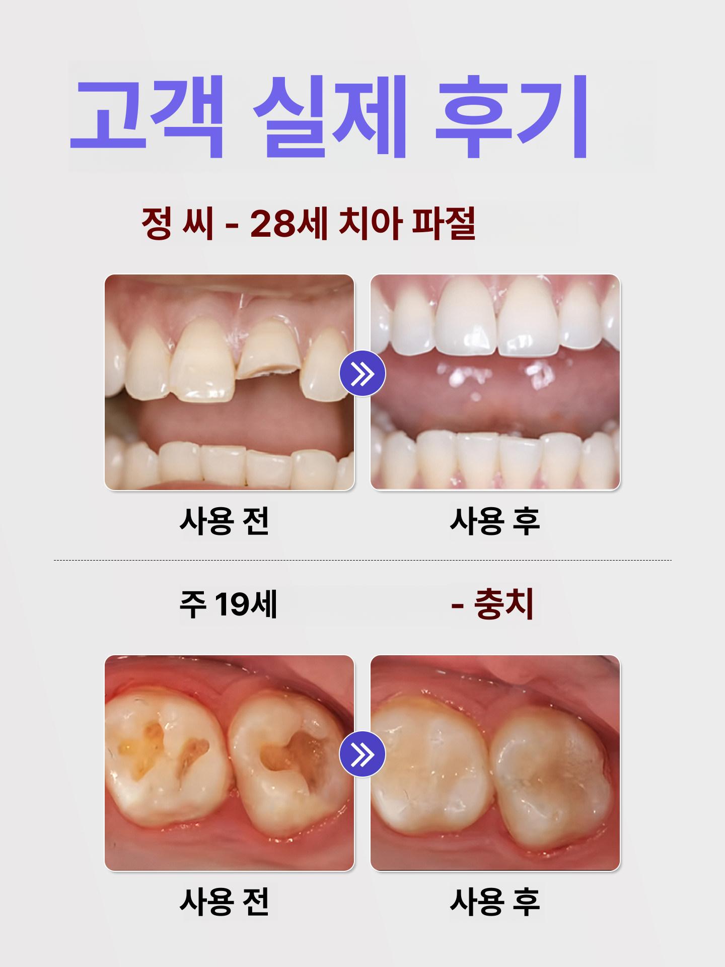 가짜이빨 부분틀니 임시치아 이빨 붙이는 치아 만들기 - 상세 이미지 3