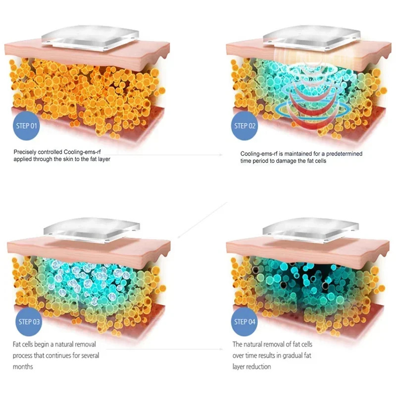 휴대Cryotherapy 불타는 Cryo 플레이트 패드 쿨 열 패들 Cryoskin criolipolisis de placas 슬림 머신