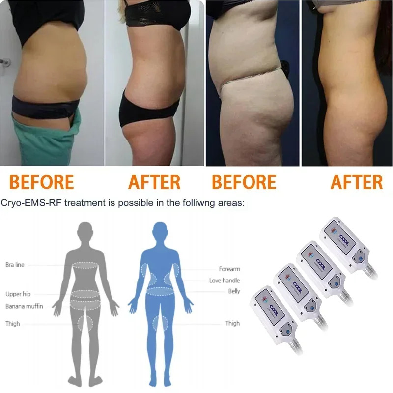 휴대Cryotherapy 불타는 Cryo 플레이트 패드 쿨 열 패들 Cryoskin criolipolisis de placas 슬림 머신