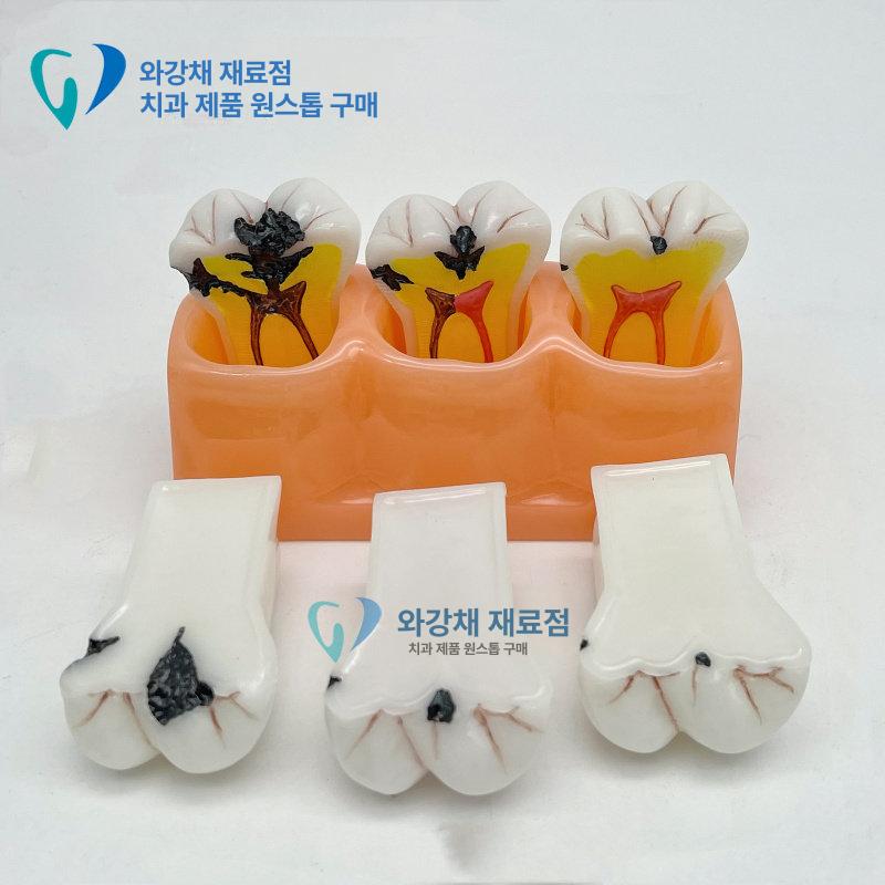 연습 치아모형 실습용 훈련 임플란트 해부학 발치형 덴티폼 교육용 교구 잇몸 이모형 - 상세 이미지 4