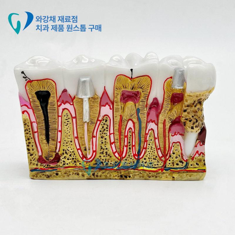 연습 치아모형 실습용 훈련 임플란트 해부학 발치형 덴티폼 교육용 교구 잇몸 이모형 - 상세 이미지 3