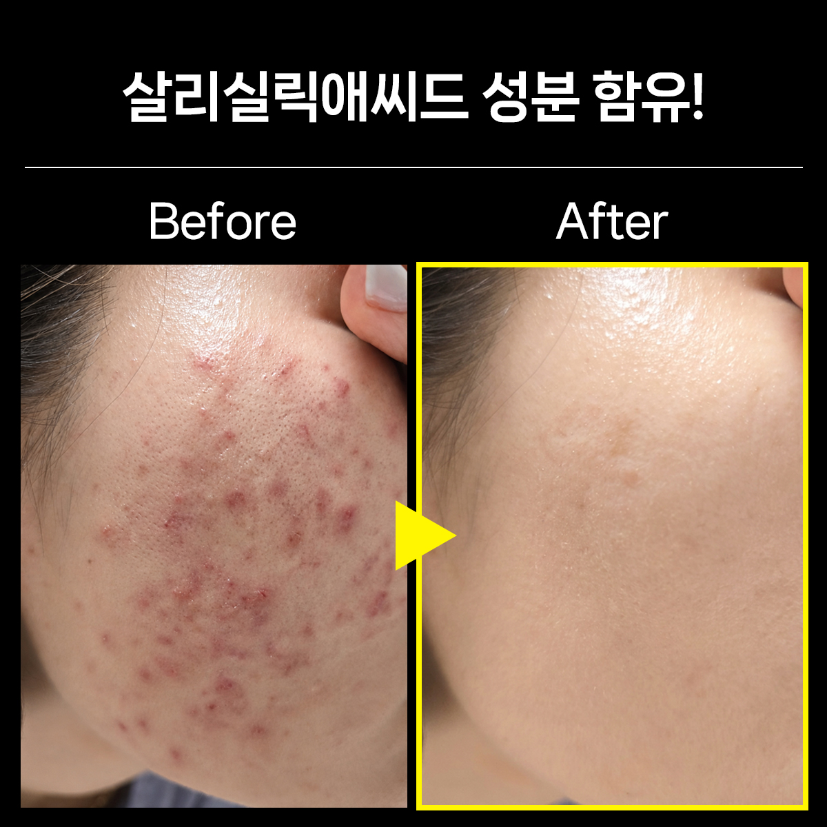 [ENTT] 트리플 피토 버블클렌저 약산성 PH 5.5 트러블, 여드름, 문제성 피지 케어 - 상세 이미지 3