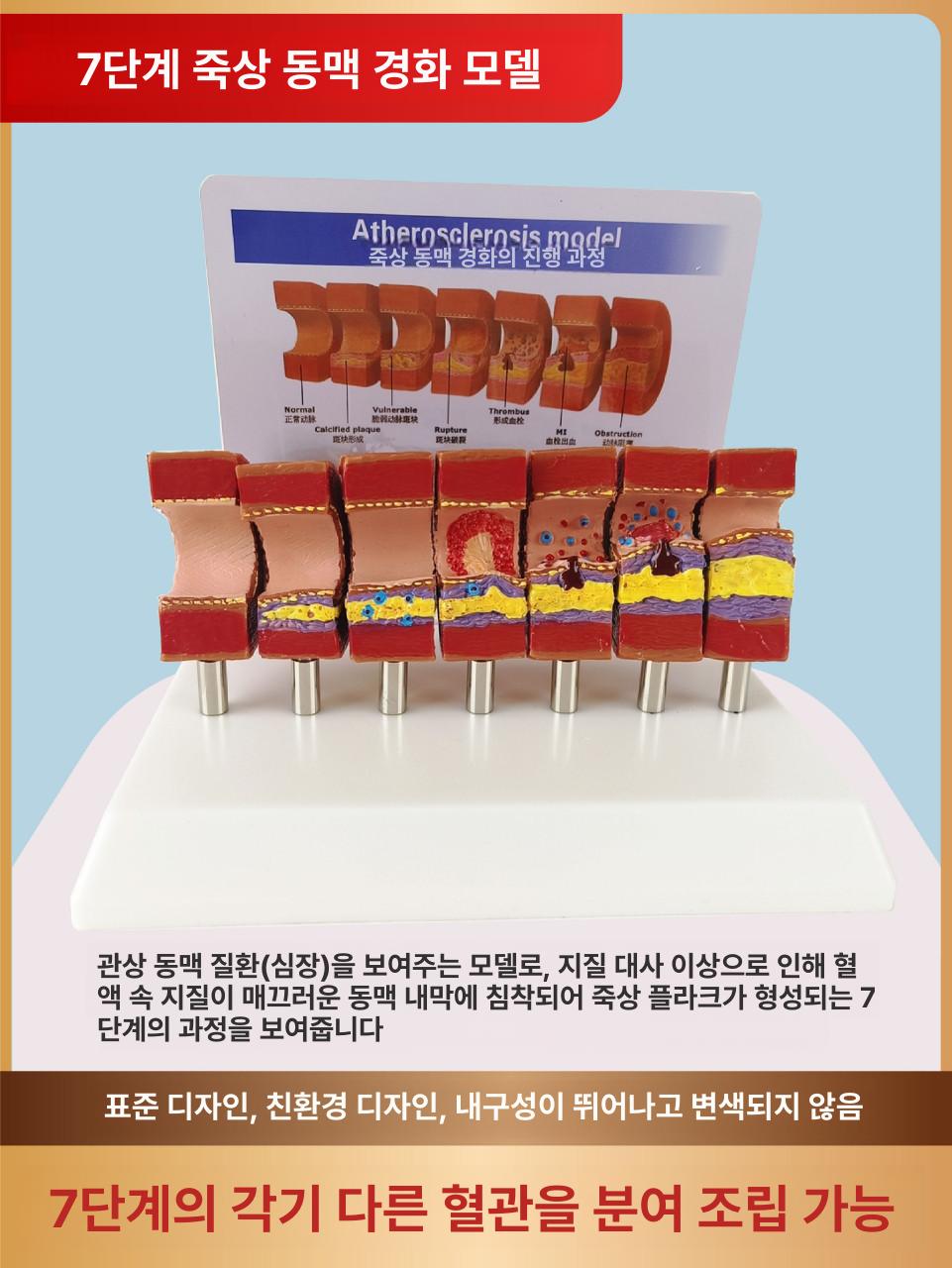 의대 혈관모형 동맥 혈전 모델 교구 해부학 교육 실습 자료 인체모형 - 상세 이미지 2