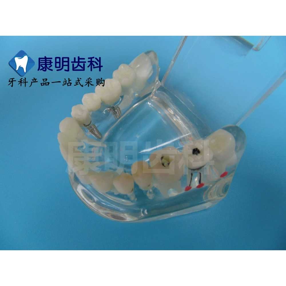 임플란트 임시치아 칫솔질 병원 투명 가짜이빨 구강 연습 모델 스케일링 치과 잇몸 - 상세 이미지 5