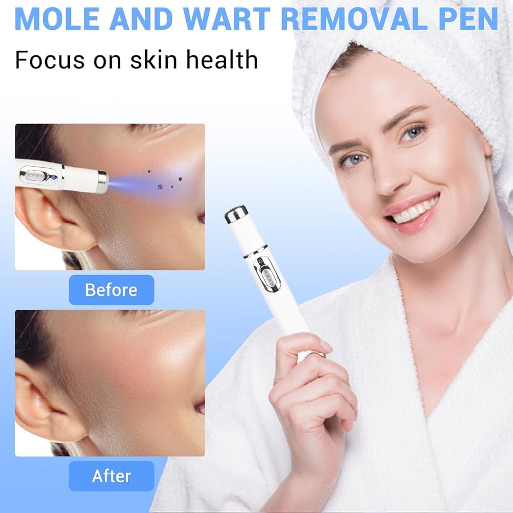 최대 강도 WART 제거제, 워트 제거 펜, 얼굴과 몸을 위한 다크 스팟 편안하고 효과적입니다. White - 상세 이미지 2