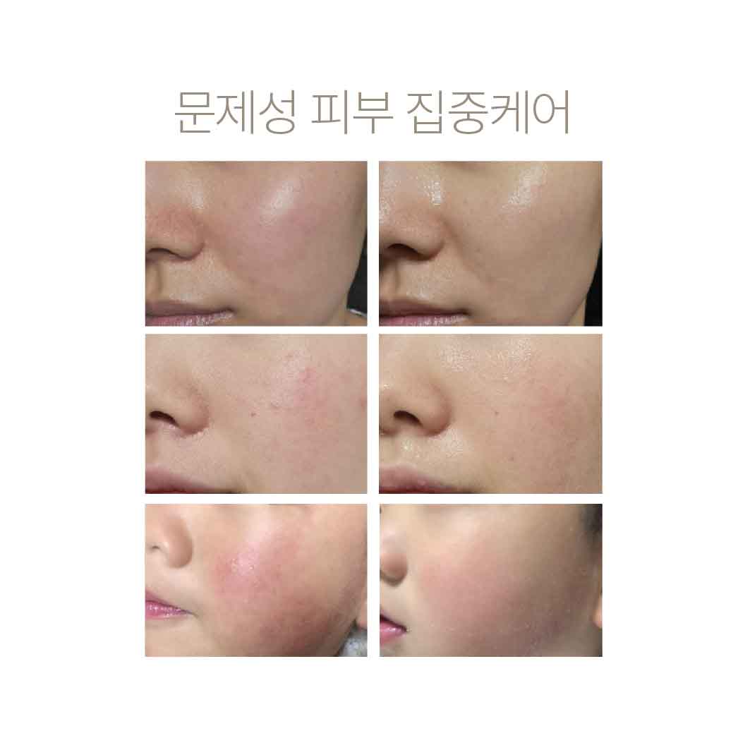 [PDRN 아토샷] 가려움 문제성 트러블 피부 아토미스트 - 상세 이미지 5