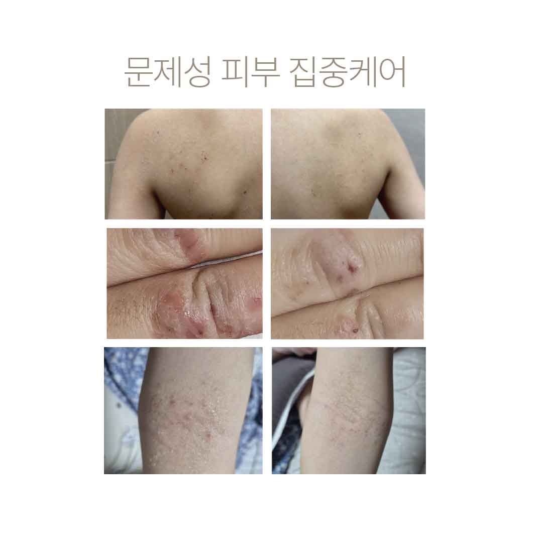 [PDRN 아토샷] 가려움 문제성 트러블 피부 아토미스트 - 상세 이미지 4
