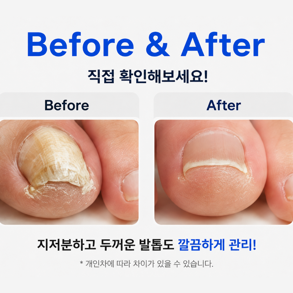 두꺼운발톱깎이 손톱깎이 대형 내성 무좀발톱깍이 관리 정리 니퍼 세트 - 상세 이미지 4