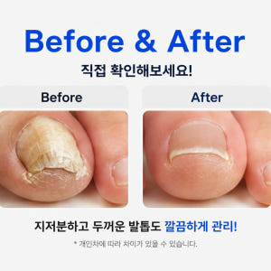 두꺼운발톱깎이 손톱깎이 대형 내성 무좀발톱깍이 관리 정리 니퍼 세트 솔직 후기 | 피부 타입별 분석 - 상품 이미지 4