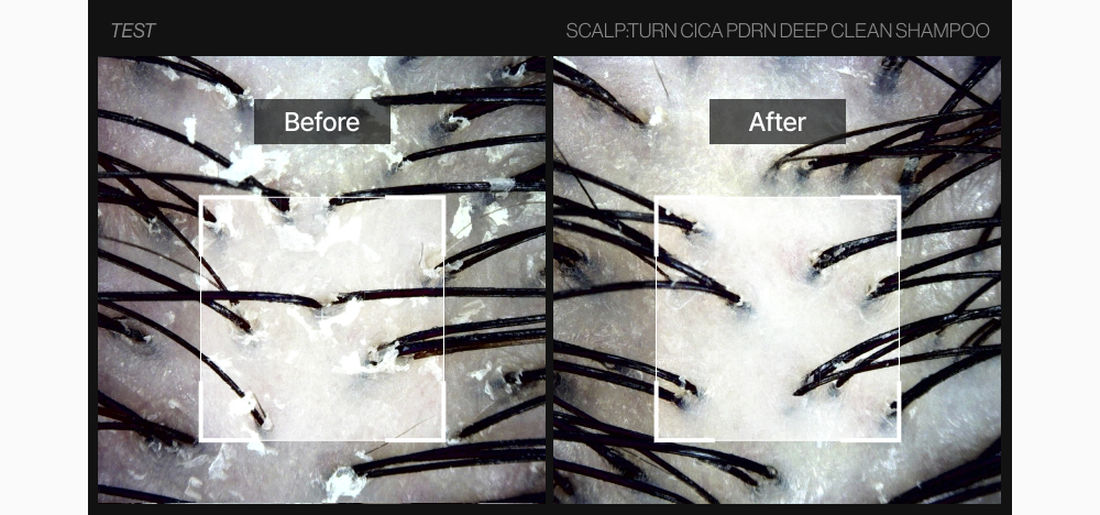 LILYEVE Scalpturn Cica PDRN Scalp Scaler - description 29