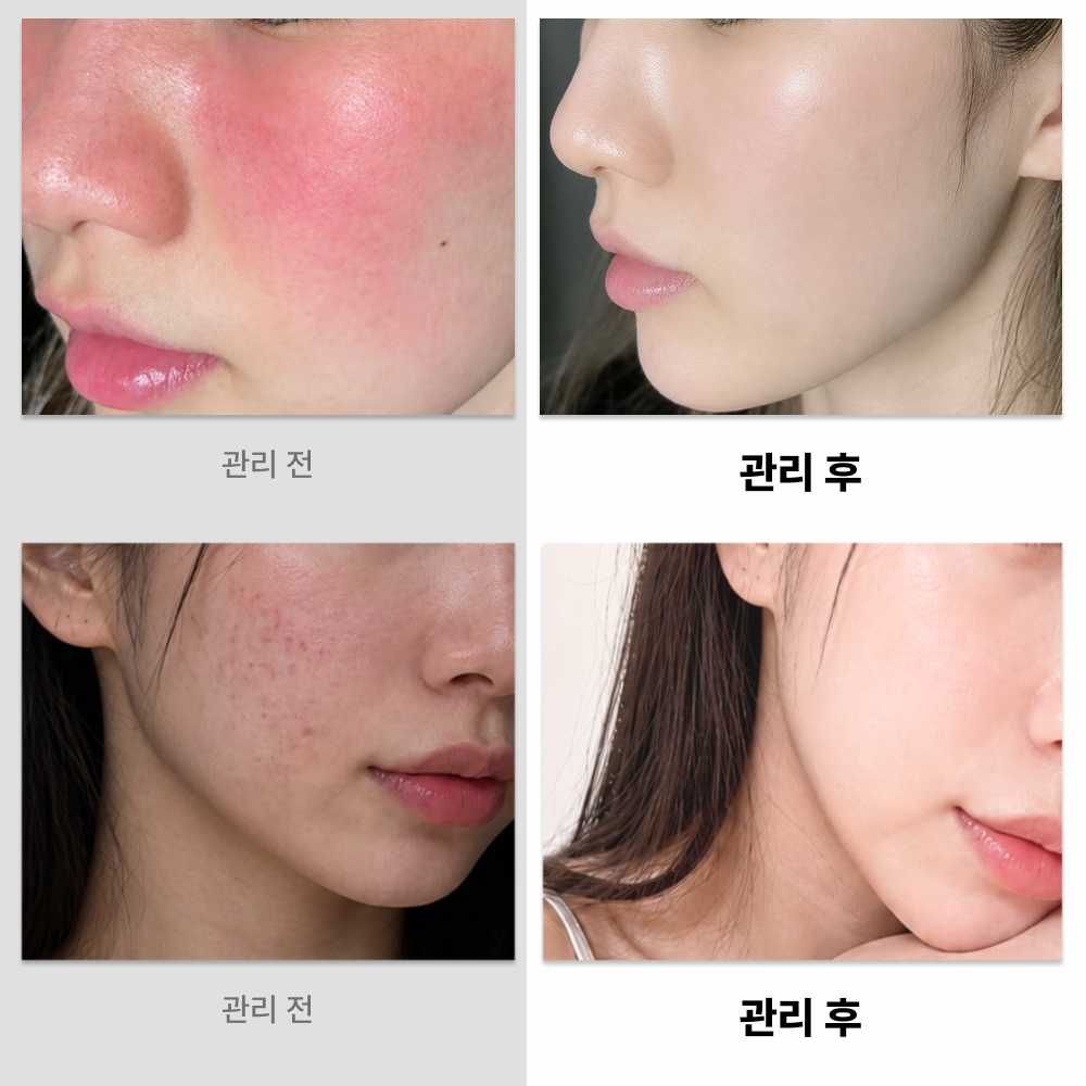 에피닝 이피셀 시카 크림 레이저 시술 점뺀 후 병풀 홍조 열건조 진정 장벽 재생 크림 - 상세 이미지 4