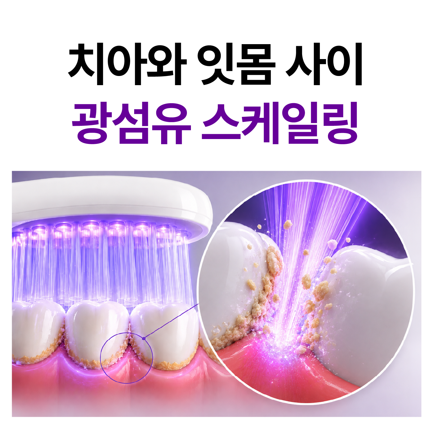실제 치과 미백 시스템 채택 / 구강탄탄 루미화이트 미백 전동칫솔 특허 보라색 LED 광섬유 칫솔모 잇몸케어 스케일링 - 상세 이미지 4