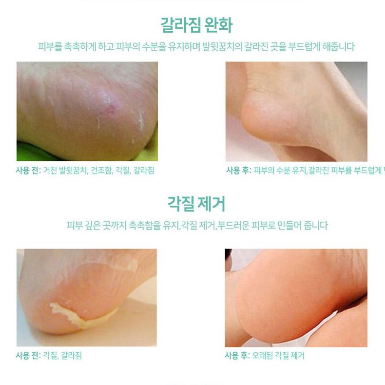 발꿈치갈라짐 실리콘발보습 뒷금치갈라짐 패드 이미지 7