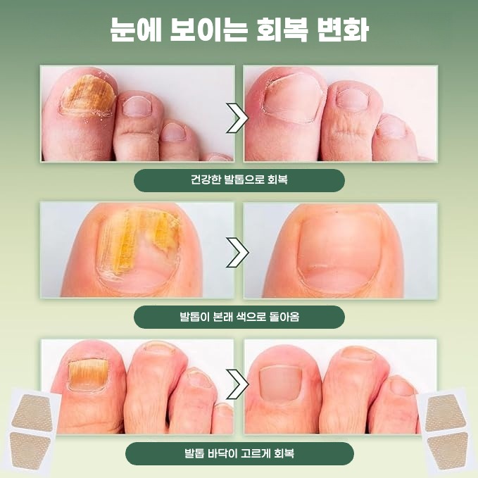 발톱무좀패치 밴드 붙이는 발톱무좀 테이프 약 한달분 발바닥수포 티눈제거밴드 - 상세 이미지 2