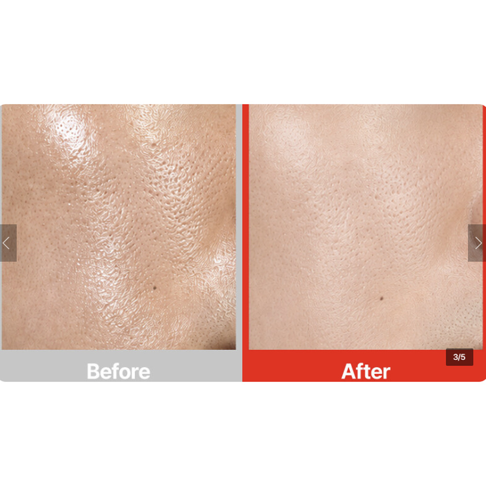 알엔아이오 퓨리톡 블랙헤드 앤 비포토너 25ml 모공 피지케어 트러블케어 - 상세 이미지 4